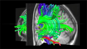 Imagen de escáner cerebral por Hanna Damasio